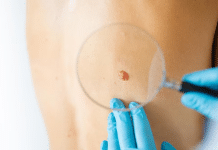 Vacuna contra el cáncer podría mejorar la supervivencia al melanoma, según ensayo